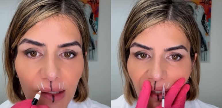 Liječnica koja pokazuje utjecaj botoksa na lice i usne