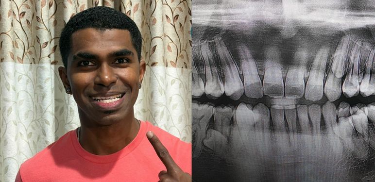 Muškarac iz Malezije Prathab Muniandy i njegovi rekordni zubi