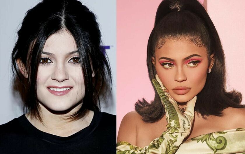 Kylie Jenner prije i poslije estetskih zahvata