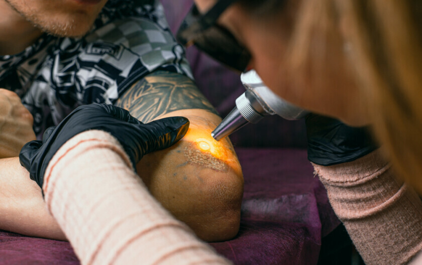 Lasersko uklanjanje tetovaže