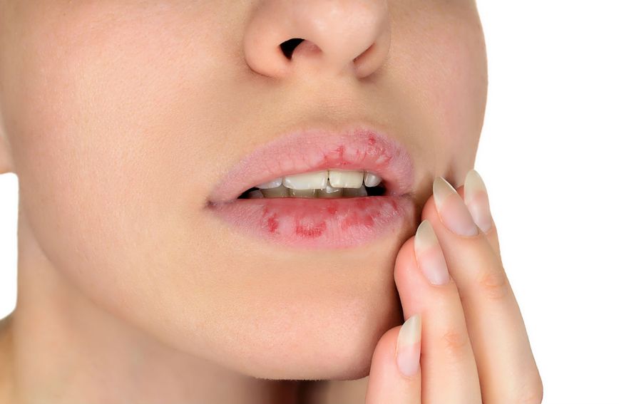 Ispucale usnice mogu značiti da je vaš organizam preopterećen