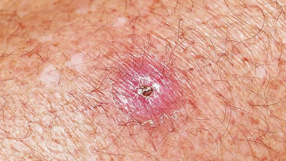 Buruli Ulcera je zarazna bolest koja se pojavljuje kao bezbolna kvrga ili oteklina i pretvara se u veći čir (Foto: University of Melbourne)
