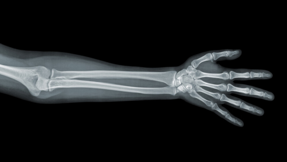 Rentgenska snimka podlaktice, ilustracija