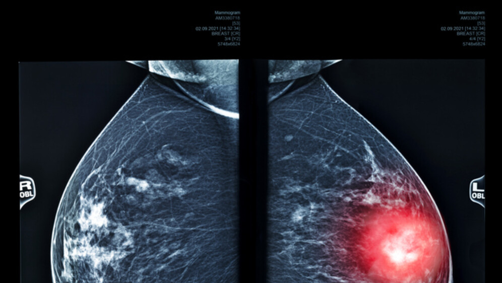 Rentgenska snimka dojki, ilustracija