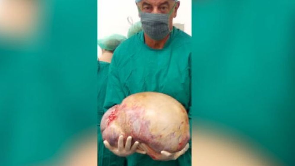 Tumor od 20 kilograma - 1