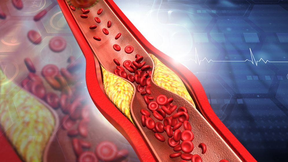 Kolesterol u krvi, ilustracija