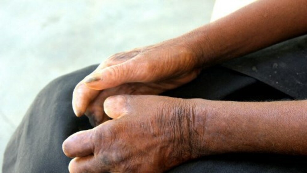 Ruke pacijenta oboljelog od gube