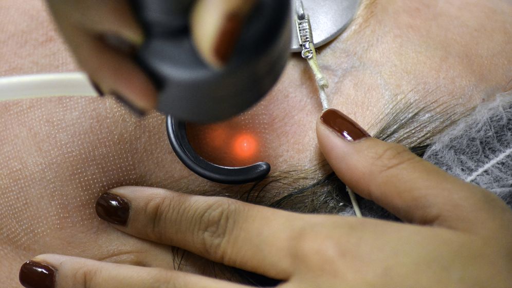 Laserski tretman, ilustracija