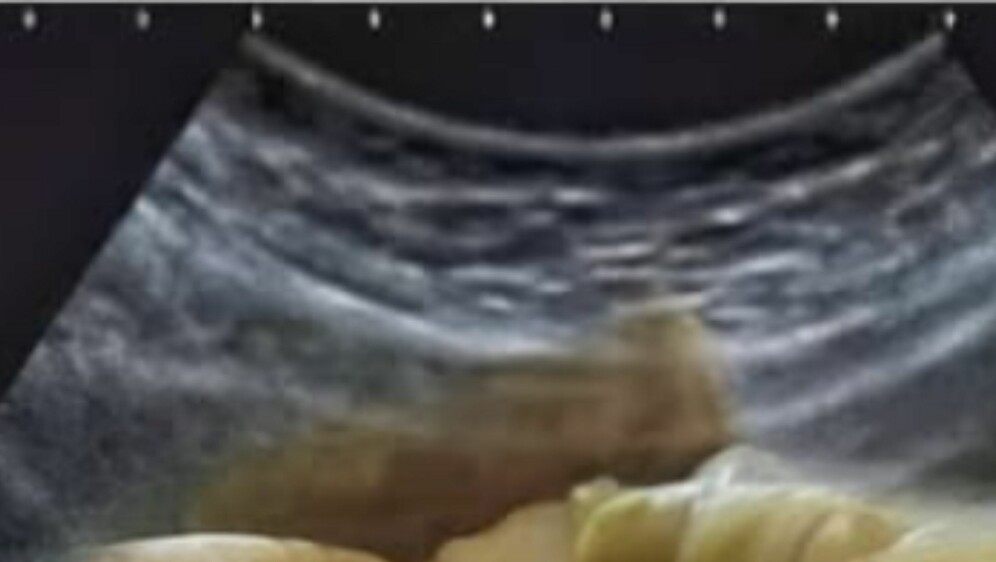 Snimka ultrazvuka sa sarmom u želucu