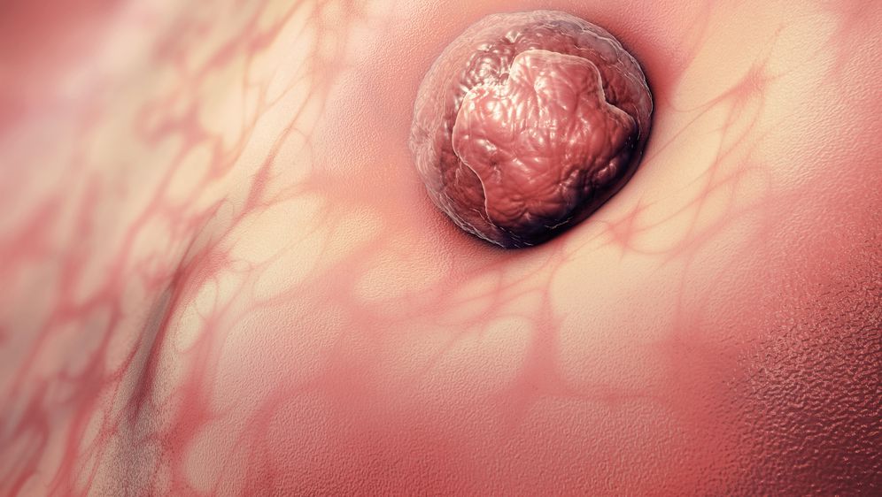 3D ilustracija jajne stanice pričvršćene za maternicu (Ilustracija: Gulliver/Thinkstock)