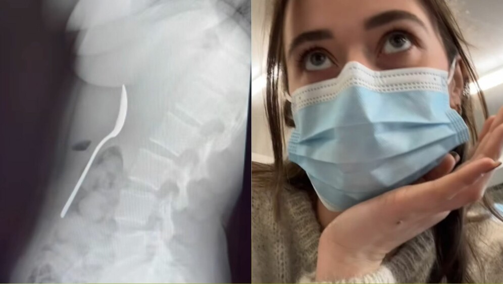 Belgijka sa žlicom u želucu