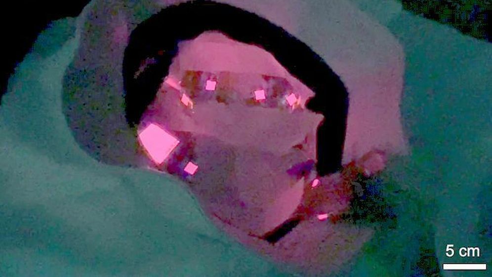 Kapa s OLED diodama za svjetlosnu terapiju vlasišta