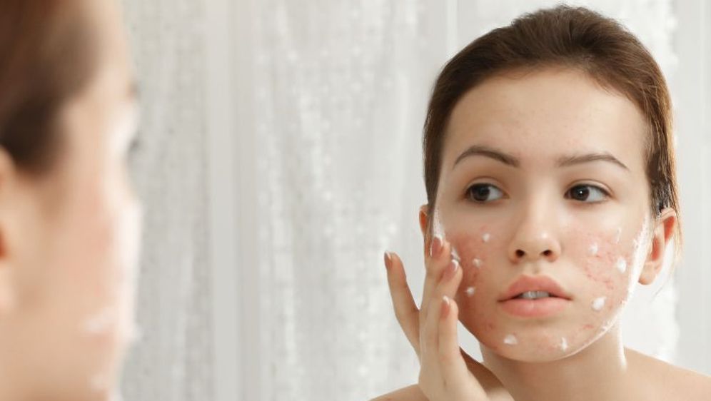 Tretiranje prištića zubnom pastom