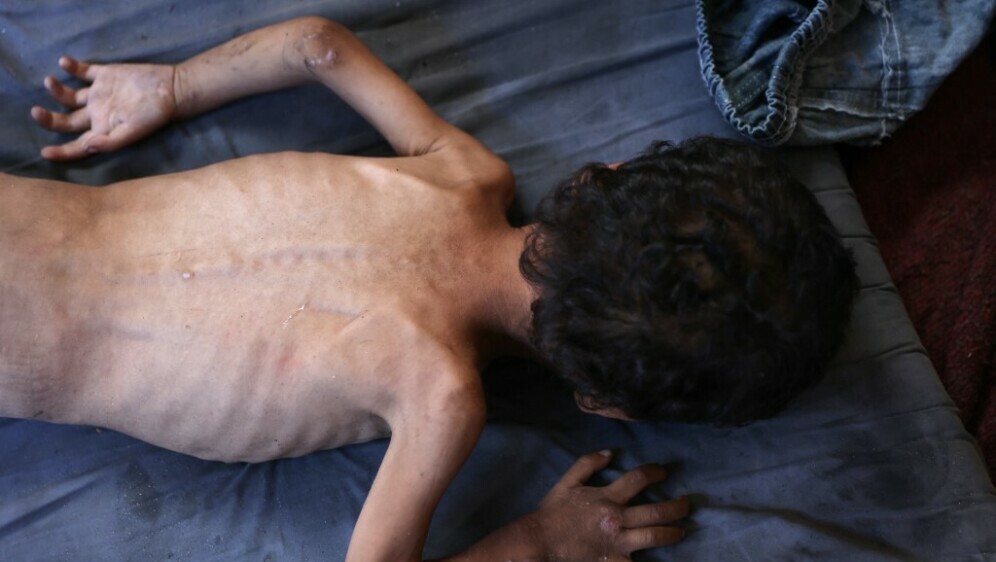 Izgladnjela djeca u Gazi