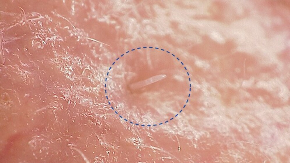 Grinja Demodex folliculorum