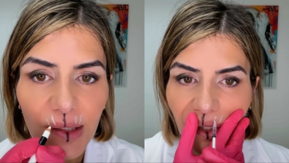 Liječnica koja pokazuje utjecaj botoksa na lice i usne