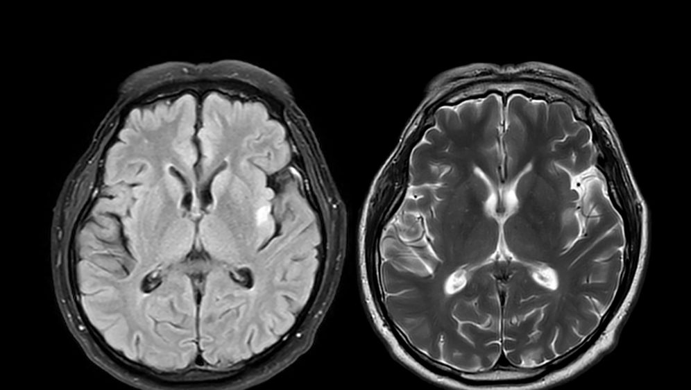 Magnetska rezonanca mozga, ilustracija