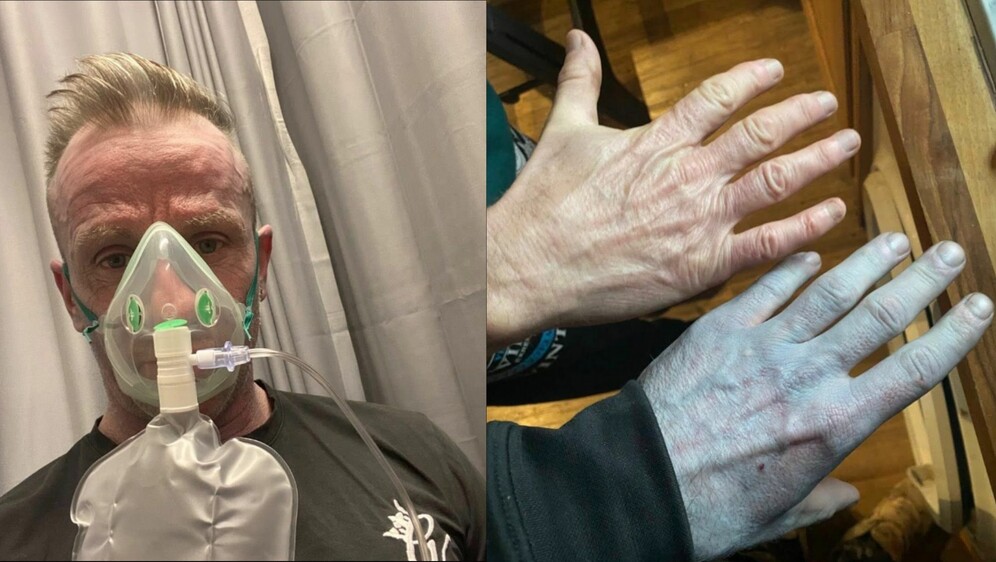 Tommy Lynch i njegovo bizarno plavo stanje