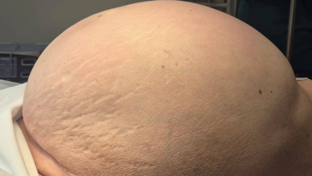 Odstranjen tumor težak 36 kilograma