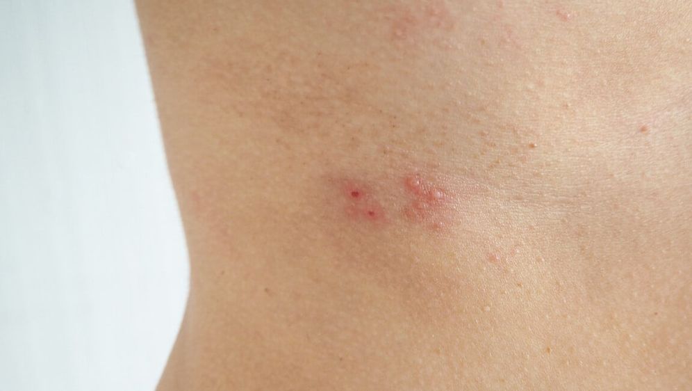 Herpes zoster prijeti ovim ljudima: Jeste li među rizičnim skupinama?