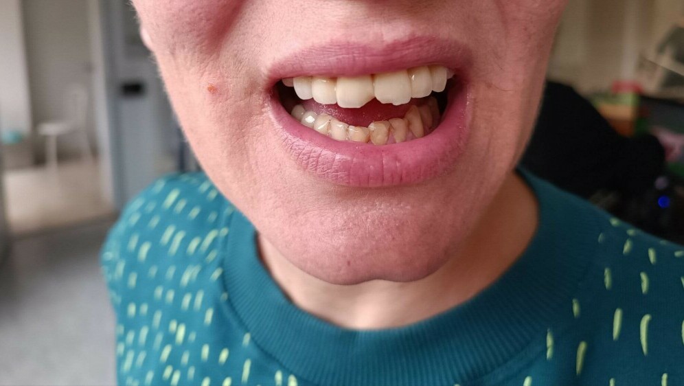 Mariji Laptalo na gastroskopiji oštetili zube