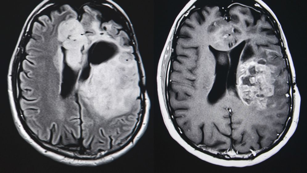 Tumor na mozgu, ilustracija