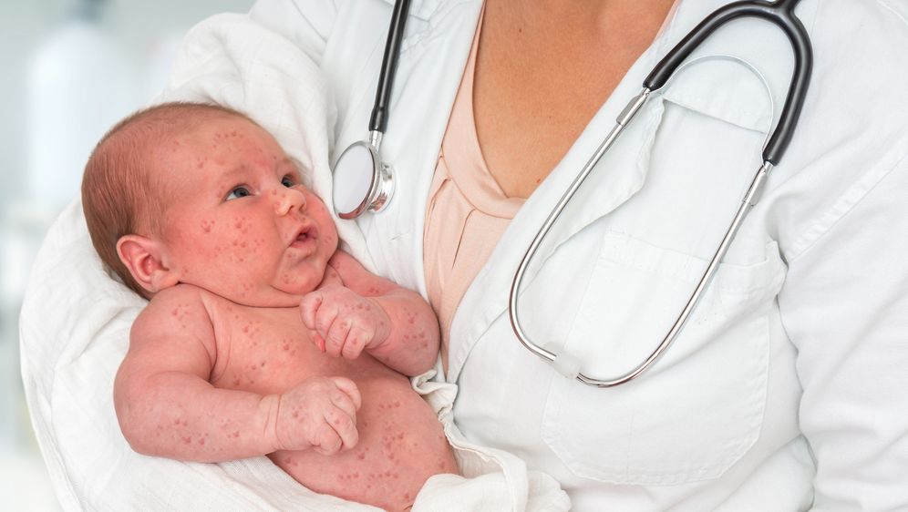 Dijete s ospicama, ilustracija