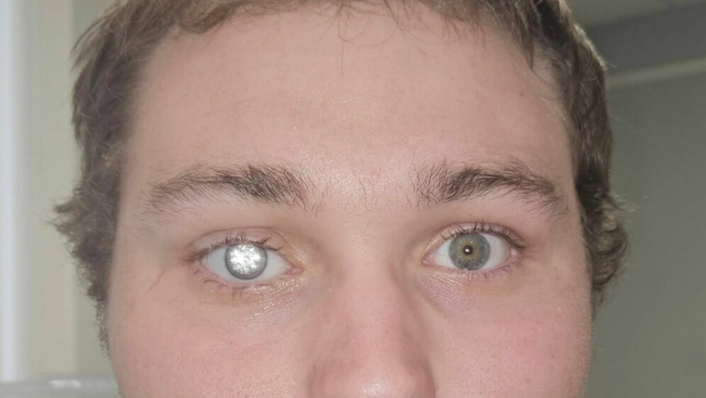 Slater Jones i njegovo proteza za oko s dijamantom