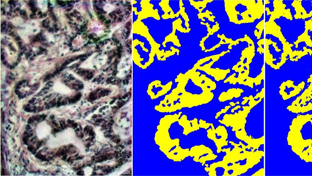 Od slike tkiva do karte tumora